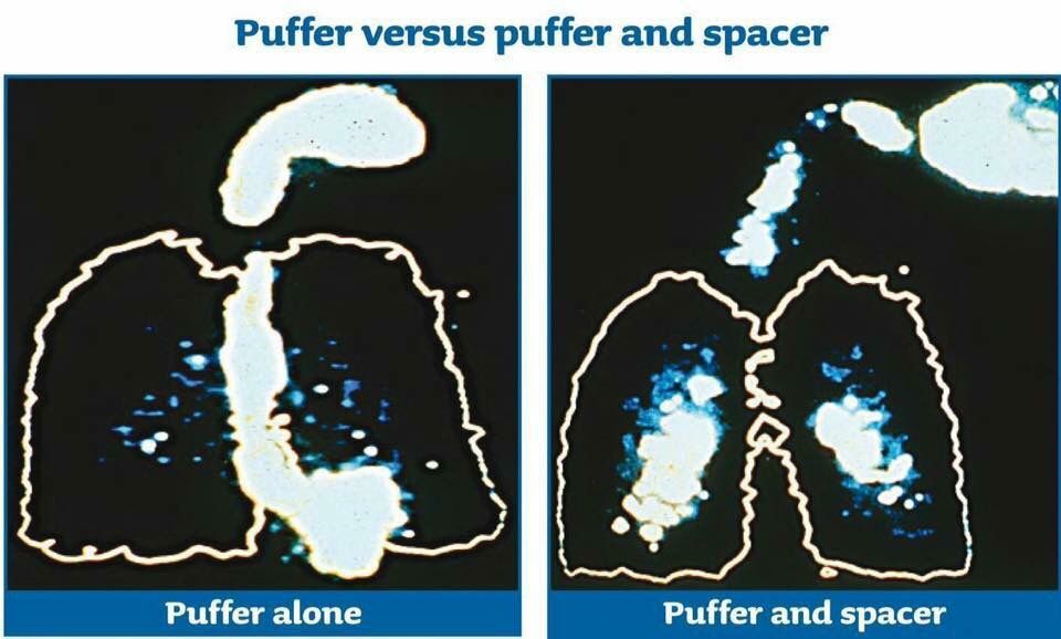 First_Aid_GC's tweet image. Spacers should be included in all First Aid Kits but they take up so much room. Click here to check out our new pop-up spacers: buff.ly/2ndm2B5