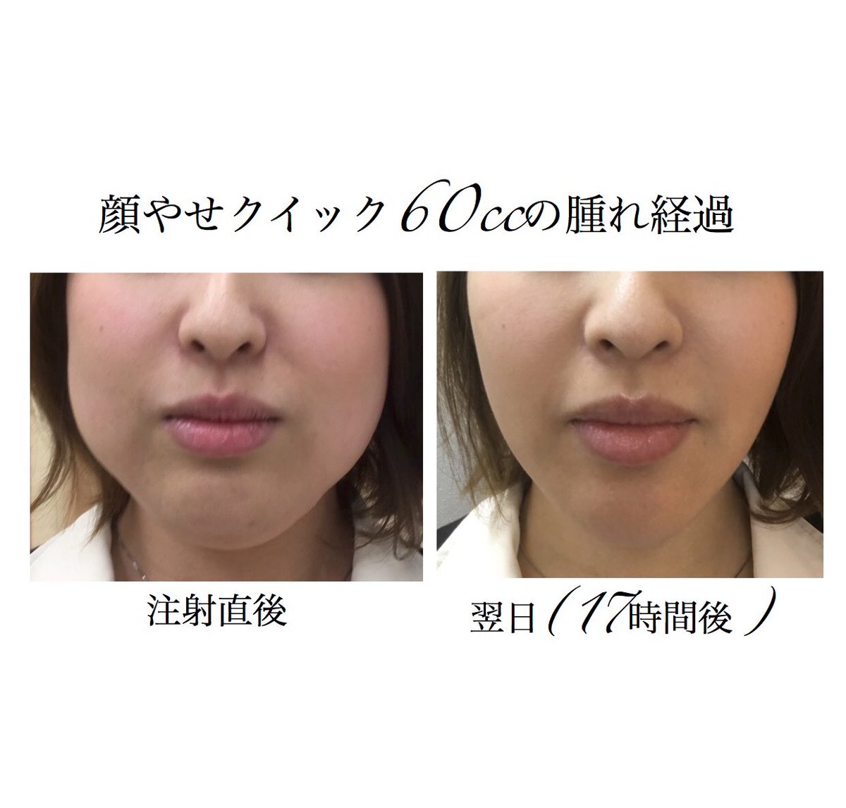 糸リフト 二重整形 鼻整形 ルラ美容クリニック院長 武内大 No Twitter 顔やせクイックの腫れ経過です 1日あれば腫れはほぼ100 引きますね ダウンタイムが取れない人にオススメの小顔注射と言えます 糸リフト 二重整形 鼻整形 ルラ美容クリニック院長 武内大 No Twitter 顔やせクイックの腫れ経過です 1日あれば腫れはほぼ100 引きますね ダウンタイムが取れない人にオススメの小顔注射と言えます