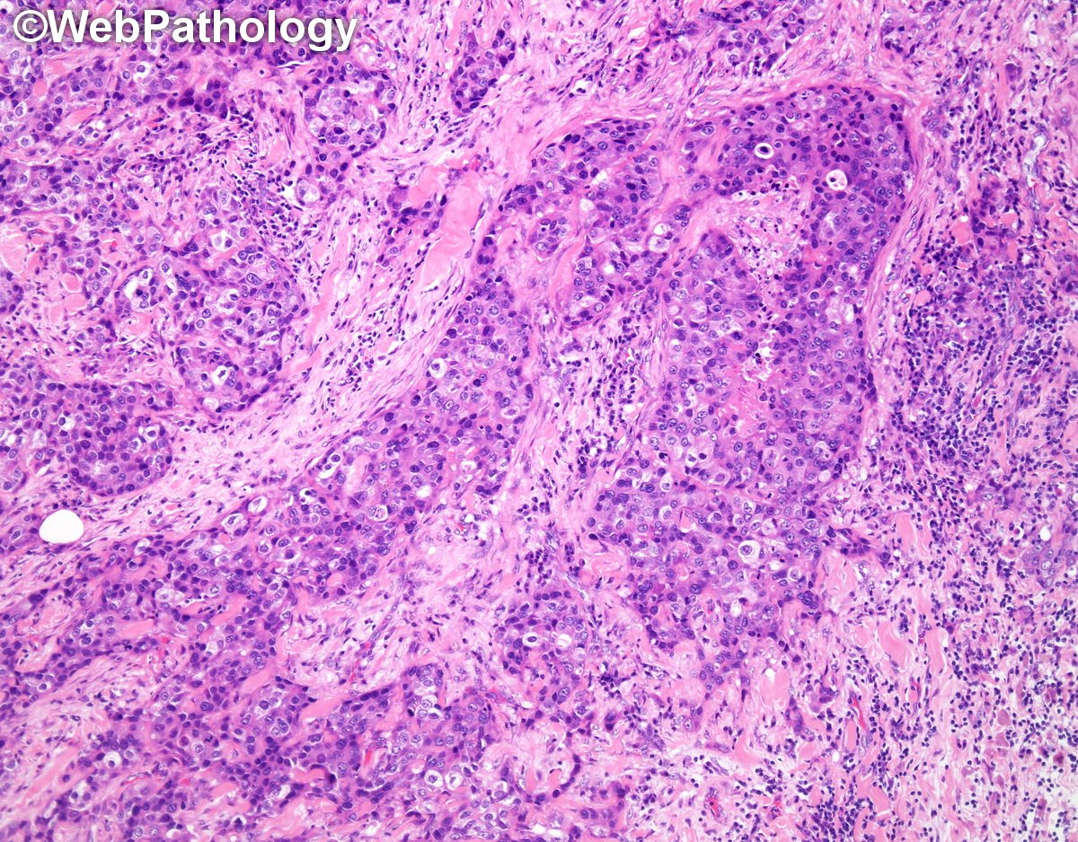 WebPathology's tweet photo. #breastpath; section on inv. ductal ca being updated; 45 images added; https://t.co/kl9ZB6iPf3; image shows #breastcancer in a male; @Pathologists @LizaMQuintana @DrKennethTang @SchnittStuart @Belinda_Lategan @BreastCancer @BreastCancerOrg @AmericanCancer @BCCare #BreastCancer https://t.co/cb1AIDn1yS