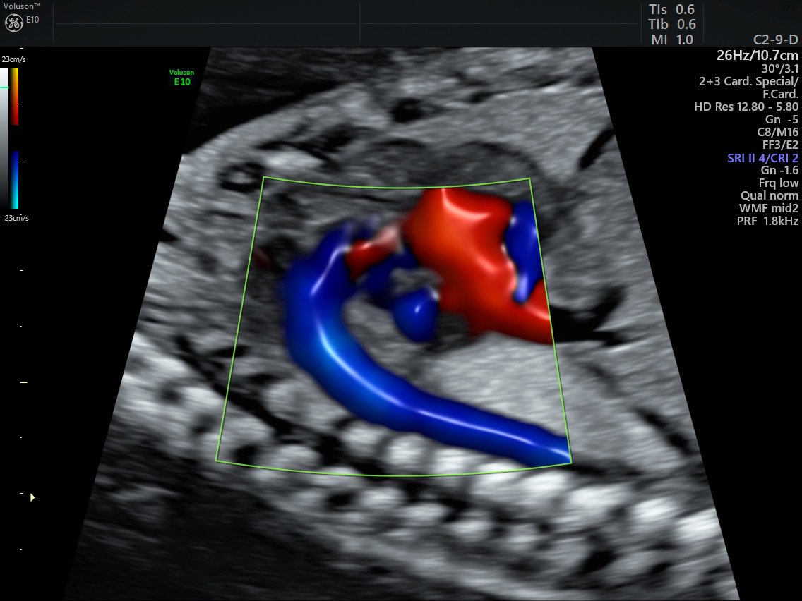 BarbDelPrince's tweet photo. 2D or 3D color? Find out the answer @ #SMFM18 #Volusoninnovation #Radiantflow at @GEHealthcare booth #SMFM. https://t.co/XRoeVs6c8J