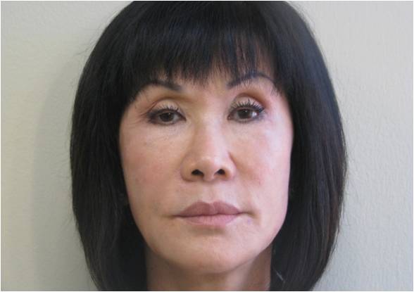 drnathannewman's tweet photo. These #beforeandafter #StemCellFacelift photos show a before, after 2 days & after 6 months. The fullness looks amazing & natural! Call us today to speak to a #StemCellLift expert and book your consultation! 310-273-3344 https://t.co/HVeIPqOA5E