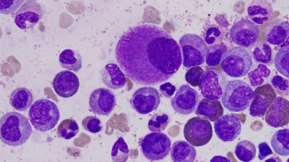 ICR_London's tweet photo. NEWS: Blocking cancer stress signal shows promise in bone marrow cancer #myeloma https://t.co/1KXVvCxf95 https://t.co/NaQHvpa6fF