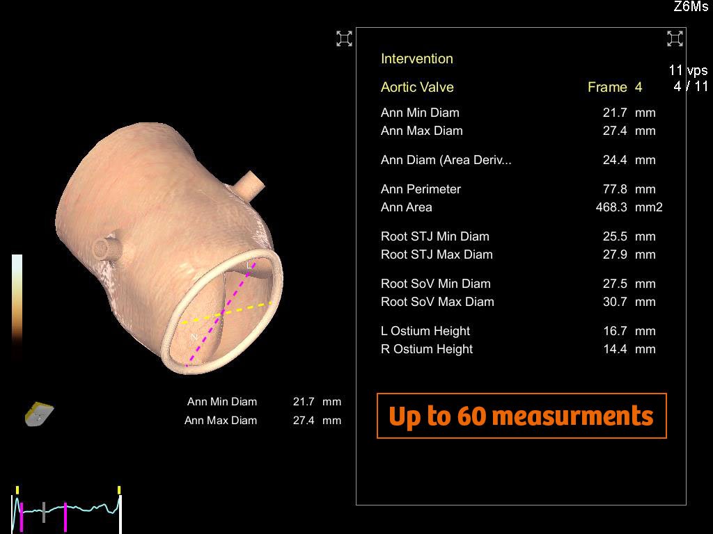 SiemensHealth's tweet photo. Enhance time-to-diagnosis with reproducible 3D valve models in 4 seconds. #ArabHealth2018 #caredelivery https://t.co/Pst0gZno15 https://t.co/VoU2E6N4GZ