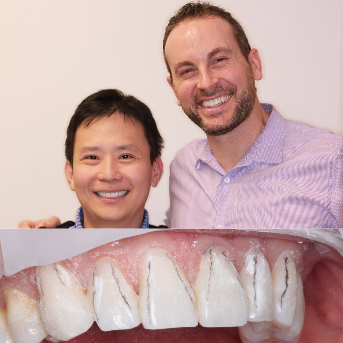 RockNRollDental's tweet photo. Using composite resin to close spaces between the teeth and cover exposed root structure! @Cosmedent @koiscenter @TheAACD @PankeyInstitute @Ivoclar_US @SpearEducation #cosmeticdentist #cosmeticdentistry #rockyoursmile #keepsmiling #passionforcosmeticdentistry #lineangles https://t.co/WIH9TEjQ3o