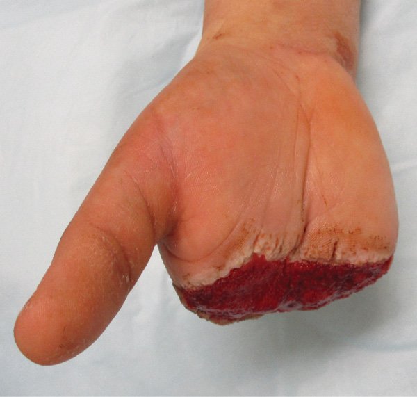 Prehospital field amputation of right hand results in positive patient outcome and is an opportunity for learning! ow.ly/L8Bt30hS2q7