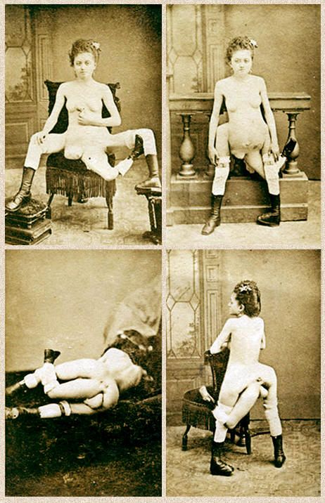 18. The woman with two vaginas.This was Blanche Dumas in 1885. She had double genitalia, bowel and bladder.To the right of her middle leg was an extra limb.For extra cash, promoters maximised its appeal by adding artificial nipples & advertising it as a pair of extra breasts.