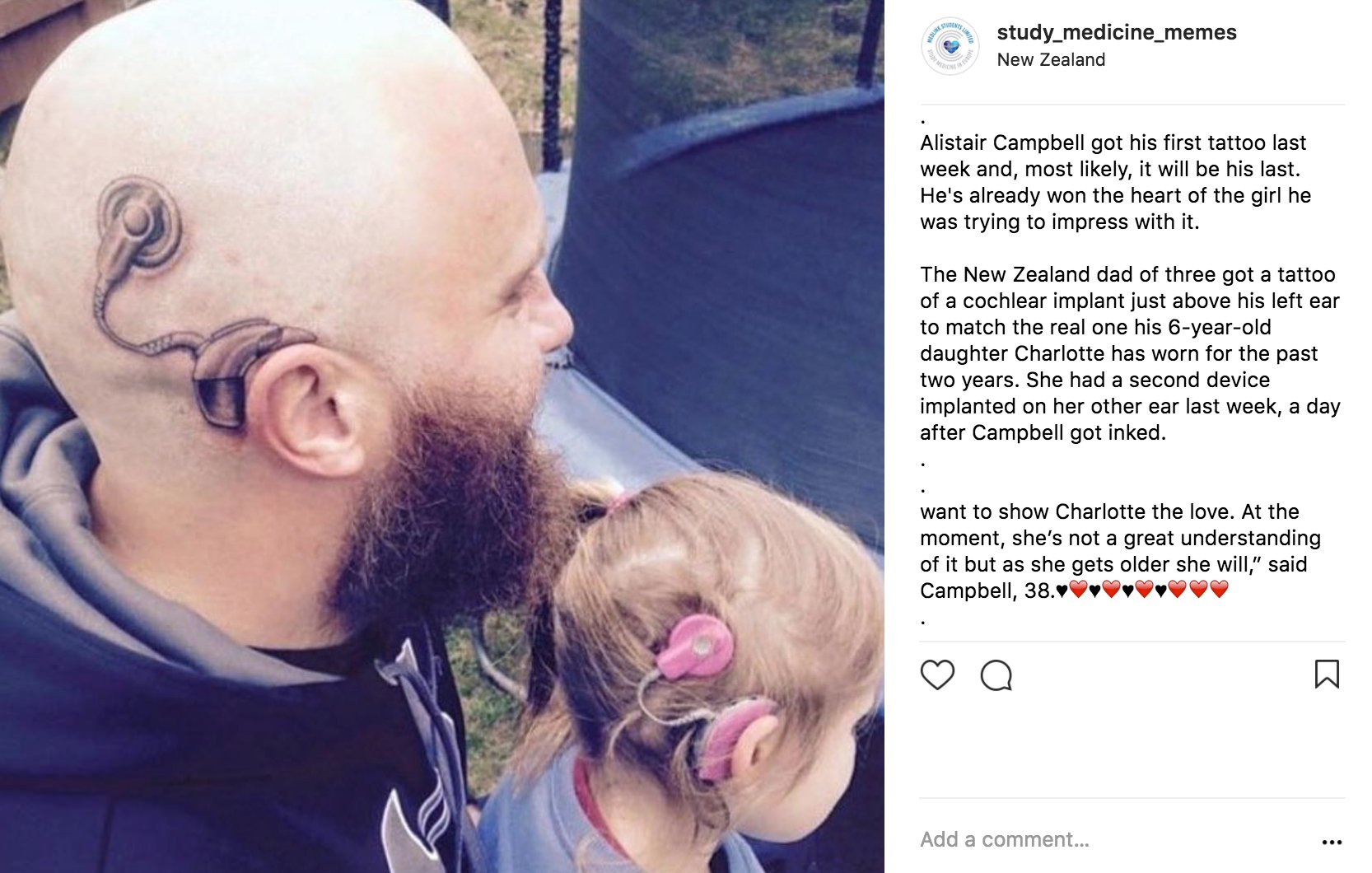 Medlink Students: Study Medicine in Europe Twitterissä: "Dad gets cochlear implant tattoo to match deaf daughter's device https://t.co/Iqho8Q1DB5 #MedlinkStudents #medical #medicine #dad #daughter #tattoo #love #medstudent #cochlearimplant #father ...
