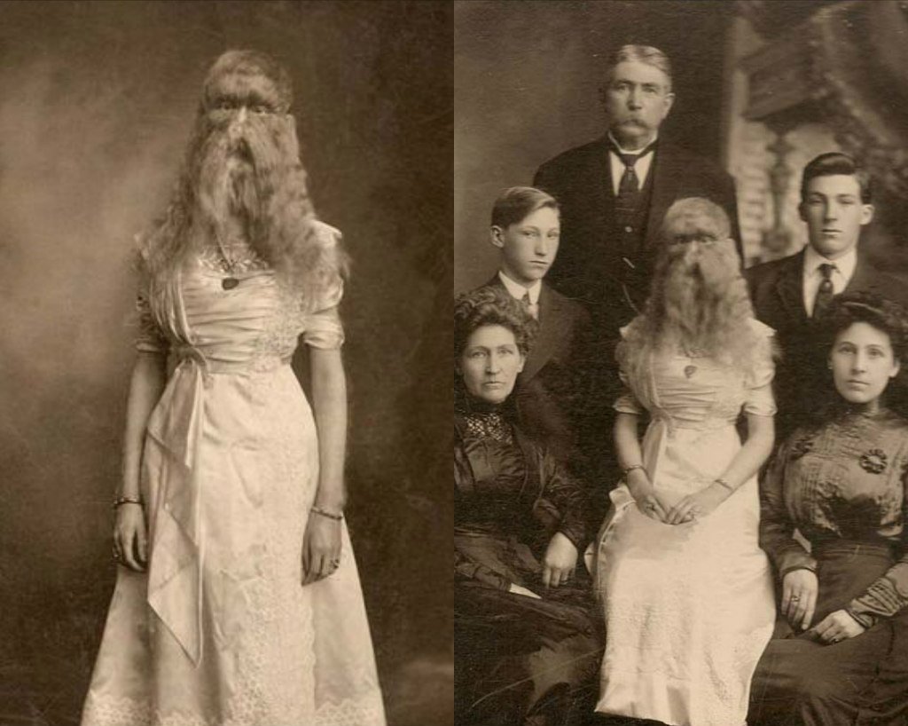 9. Alice E. Doherty was born in 1887 with a rare genetic mutation called “hypertrichosis”, or “werewolf syndrome”, which causes excessive body hair.She is the only known person with the condition born in the United States.