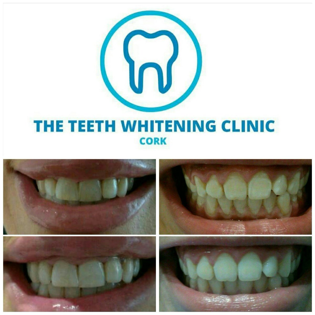 TTWCCork's tweet photo. Unlike other teeth whitening processes that require weeks or months of routine treatments, with #Laserteethwhitening you can see visible results in just one hour. 
Call 021 4274705 or PM to book an appointment
#teethwhiteningcork https://t.co/wdFkSfcmC4