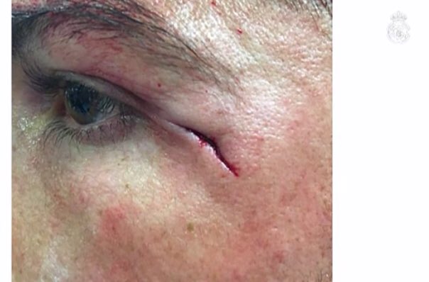 Julio Touza (@juliotouza) on Twitter photo La brecha de <a href="/Cristiano/">Cristiano Ronaldo</a> a milímetros del ojo. Un tío que ha metido más de 600 goles, jugándoselo todo por meter uno más en un partido ganado. Donde los mediocres ven egolatría lo que hay es profesionalidad en grado superlativo. La brecha de <a href="/Cristiano/">Cristiano Ronaldo</a> a milímetros del ojo. Un tío que ha metido más de 600 goles, jugándoselo todo por meter uno más en un partido ganado. Donde los mediocres ven egolatría lo que hay es profesionalidad en grado superlativo.