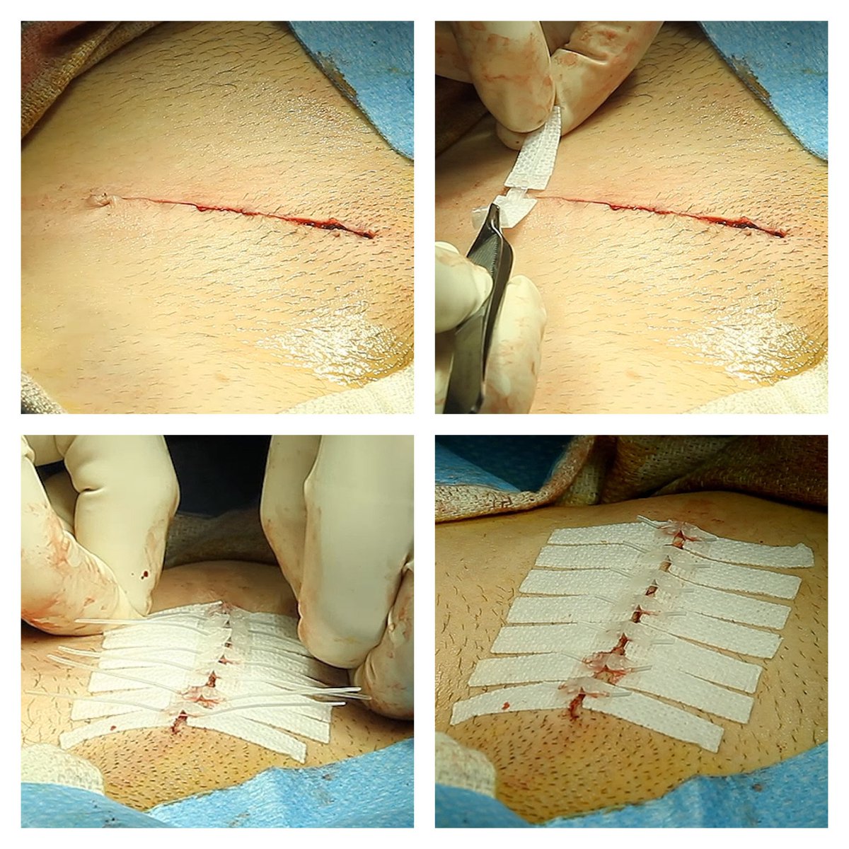 DermaClip's tweet image. Most efficient, advanced and cost-effective alternative to traditional skin closure process of #surgical_staples, sutures and skin glues - DermaClip® non-invasive skin closure device. Contact DermaClip® US, L.L.C. to know more details!dermaclipus.com/pages/the-derm…