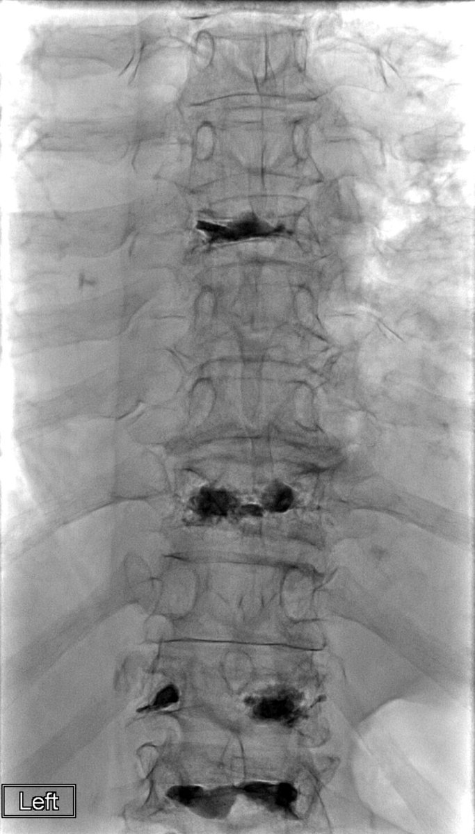 Dr. Joseph Ronsivalle performs a multilevel #kyphoplasty <a href="/guthrie_ir/">GuthrieIR</a> in Sayre, PA