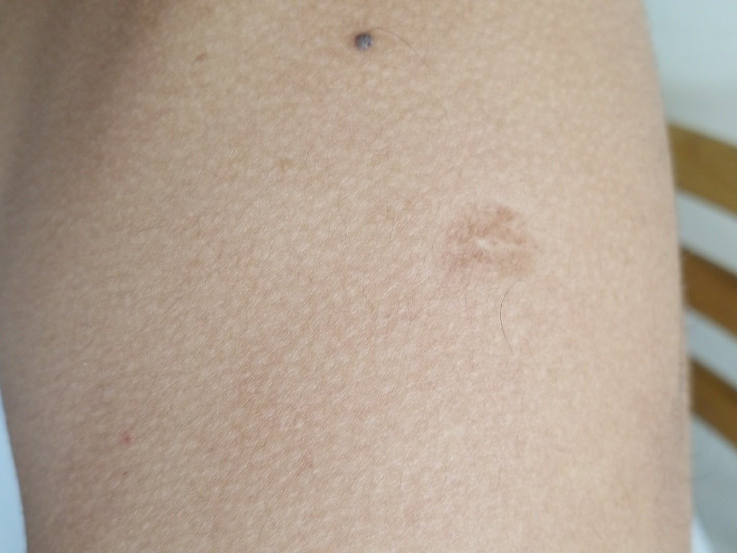Felipe Esparza on X: "A small pox vaccination scar always gives away your  true age. https://t.co/ToIplSgsuK" / X
