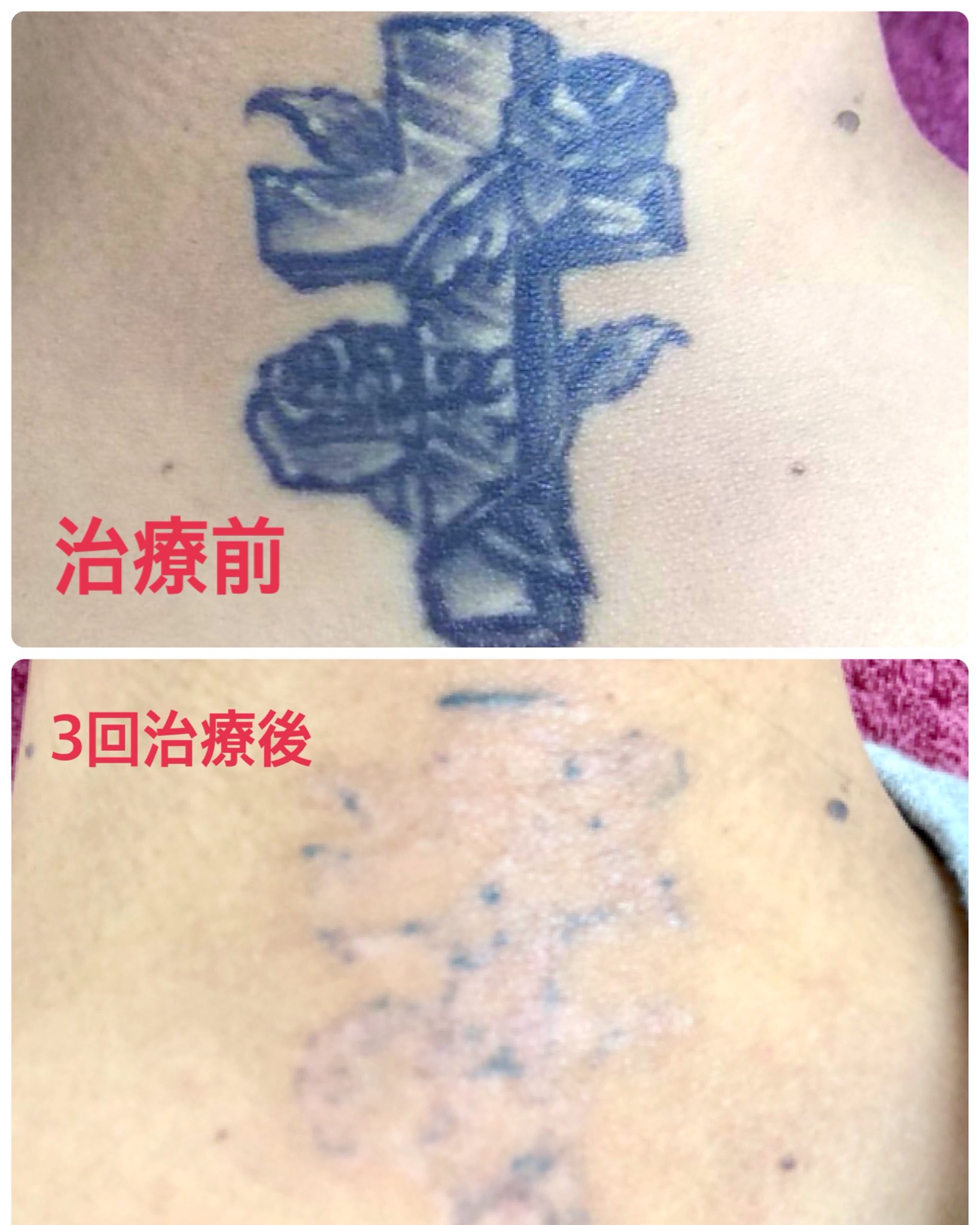 キルシェクリニック Dr めかた わずか3回のレーザー治療で ここまでタトゥーが消える と嬉しいですね 元々がこんなに濃くて大きなタトゥーだったと想像できる人はいないはずです ピコレーザーなら こういった経過の患者さんもたくさんいますよ