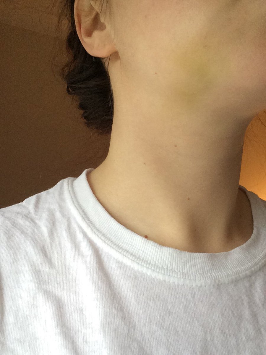 Emilyborchardt3's tweet photo. @IamChouquette Please choose me! Im home with a bruised face after getting my wisdom teeth out need some coverage! #iamchouquettefamily #bruised https://t.co/HUIcSH1paU