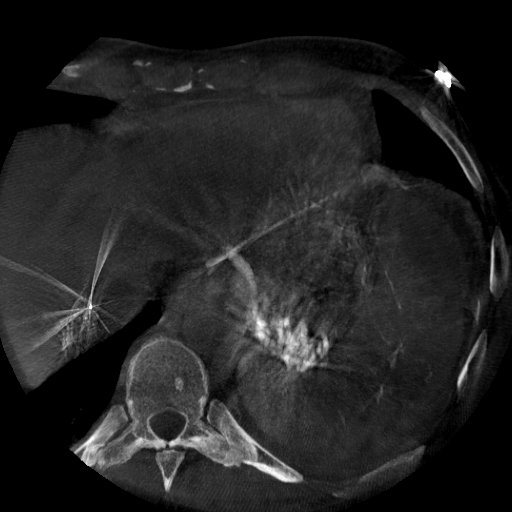 Arterial 'varices' (left gastrics -&gt; short gastrics -&gt; spleen) causing massive upper GI bleeding, post main splenic artery embolization for aneurysm