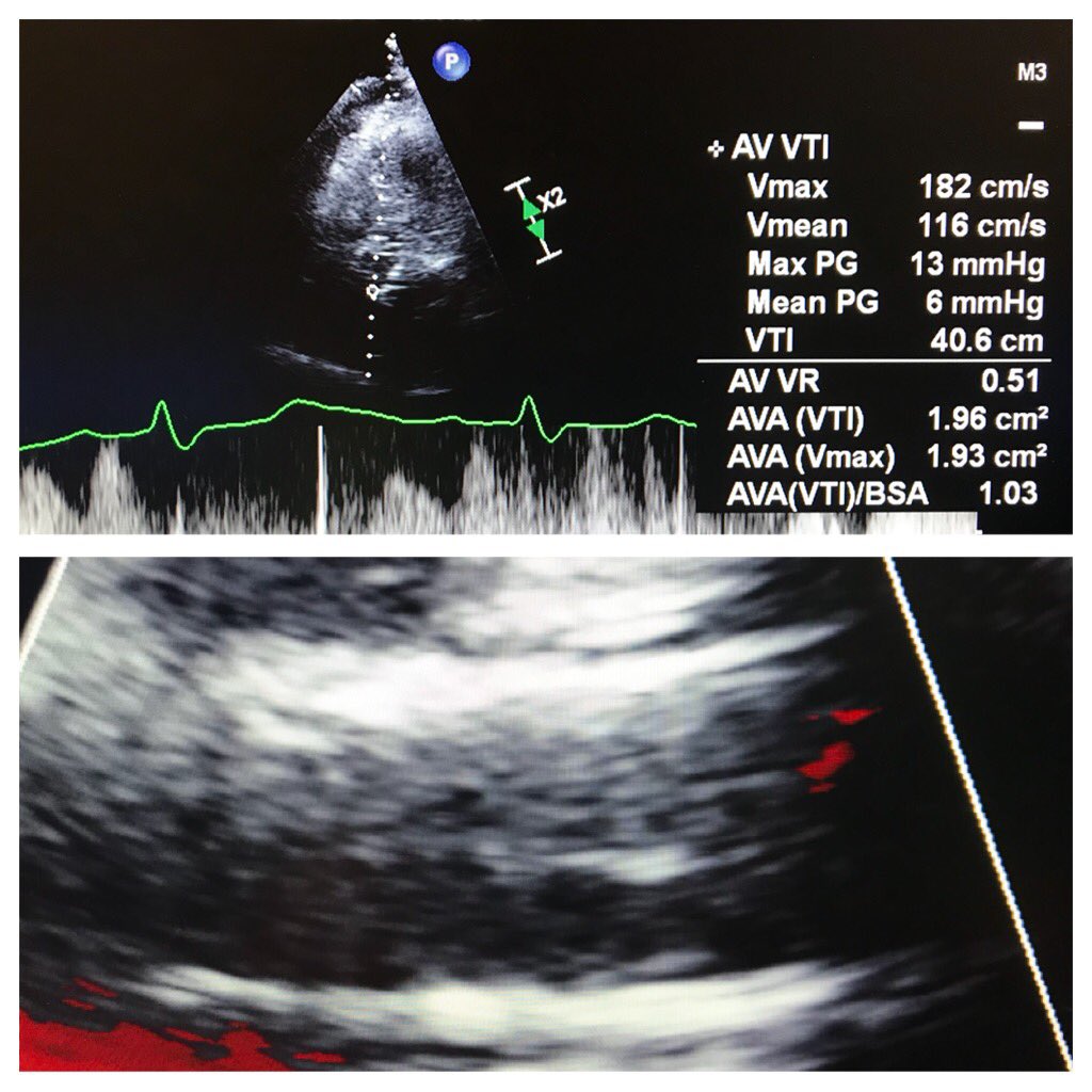 Rahul2282Sharma's tweet image. “Learning to Burn” w/ @JasonFoerst on my 1st #Transcaval access.  Did #TAVR S3 23: 🚫PVL, mean AVG=2 by Cath, 6 by Echo; Final transcaval w/ minor Ao-C flow, type 1 closure.  #CarilionStructural @CarilionSHD @Mjoseph3324 @SulaimanRathore @ShereeEmore @carmenhsalmon