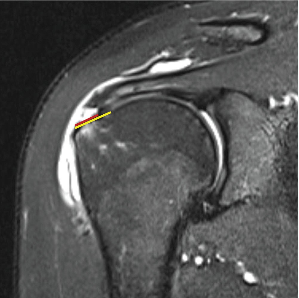 aossmjournals's tweet photo. What is the fate of high-grade partial-thickness tears of the supraspinatus, treated nonoperatively? A one year MRI study: https://t.co/HndpZ3fDeU https://t.co/xZFklfes4y