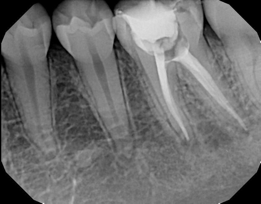 DrRicoShort's tweet photo. The SHORT Case Of The Day!
Tooth #19...Anatomy
We don't create canal anatomy but we get an opportunity to bask in it's wonders after a well done root canal. 
#5Canals

Dr. Rico D. Short
Board Certified Endodontist
Apex Endodontics P.C / Atlanta https://t.co/KxxmQuIXrE