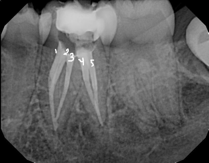DrRicoShort's tweet photo. The SHORT Case Of The Day!
Tooth #19...Anatomy
We don't create canal anatomy but we get an opportunity to bask in it's wonders after a well done root canal. 
#5Canals

Dr. Rico D. Short
Board Certified Endodontist
Apex Endodontics P.C / Atlanta https://t.co/KxxmQuIXrE