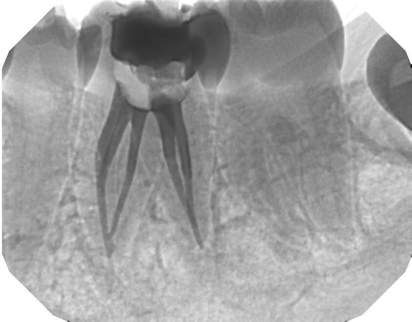DrRicoShort's tweet photo. The SHORT Case Of The Day!
Tooth #19...Anatomy
We don't create canal anatomy but we get an opportunity to bask in it's wonders after a well done root canal. 
#5Canals

Dr. Rico D. Short
Board Certified Endodontist
Apex Endodontics P.C / Atlanta https://t.co/KxxmQuIXrE