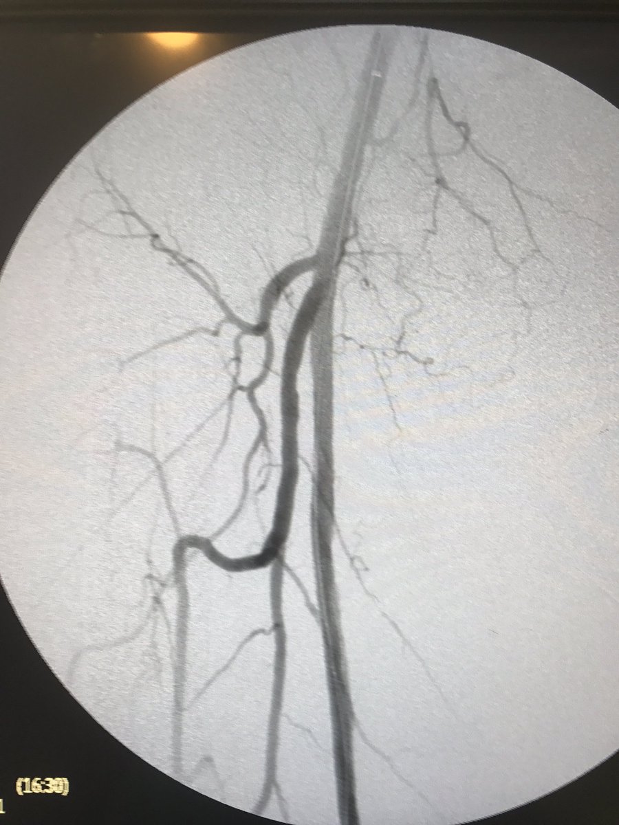 omarsaleh66's tweet image. Part 2 of 53 yo patient w sfa occlusion and 1 vessel runoff . Sfa/pop treated w #supera and zilver ptx. Distal AT tx w #rotablator. #NEO