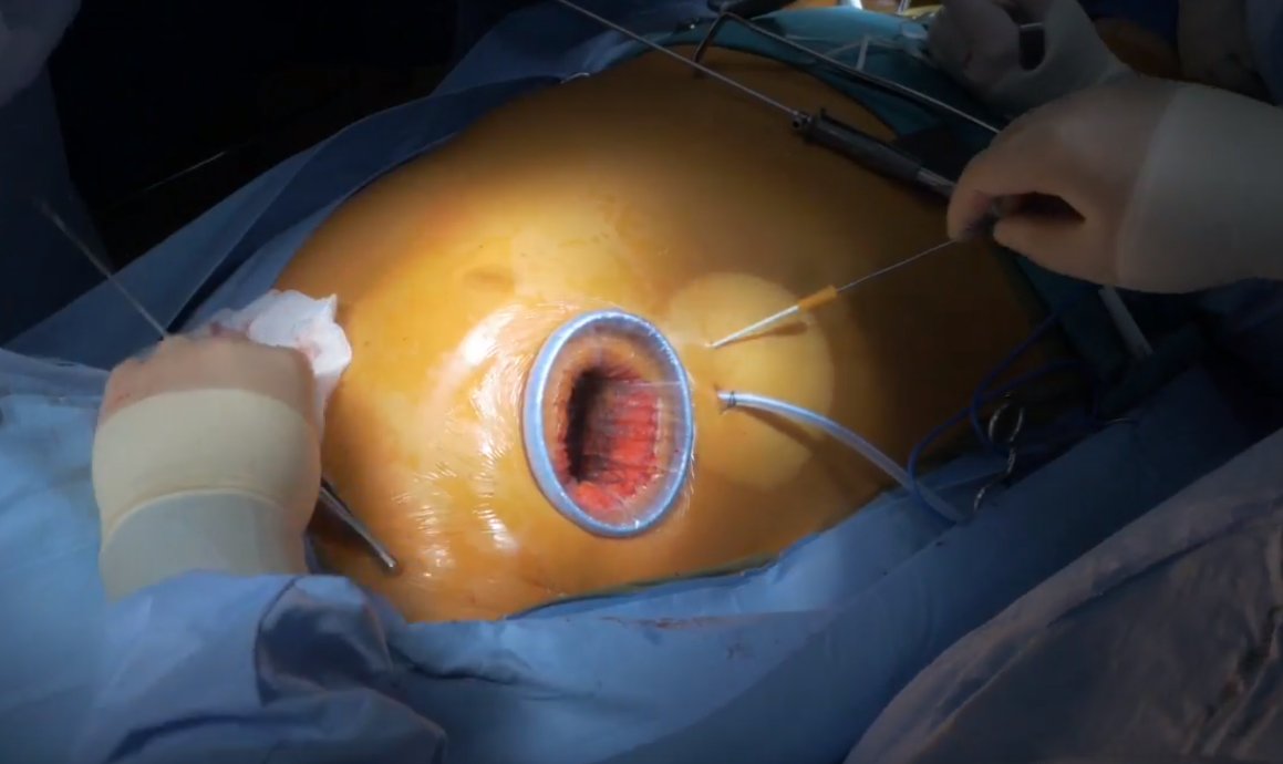 ctsnetorg's tweet photo. Next in our Guest Editor Series - Advances in Minimally Invasive Valve Surgery: Port Access and #Minithoracotomy Mitral #Valve #Surgery #tssmn #ctsurgery #ValveDisease #Cardiac https://t.co/2rdrHkcEFE https://t.co/VBqUxh743u