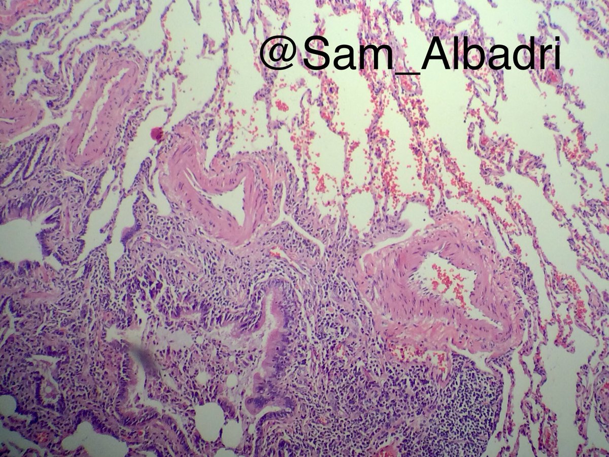 sam_albadri's tweet image. Classic picture of connective tissue disease (RA; in this case). Chronic bronchiolitis w mild scarring of small airways &amp;amp; OP @kabeerkshah @GeronimoJrLapac @VijayPatho @LizaMQuintana @marcoslepe @plessthanpt001 @ElshaikhMD @Sinchita_Roy @NadiaUSAMC #Pathologists #pulmonarypath