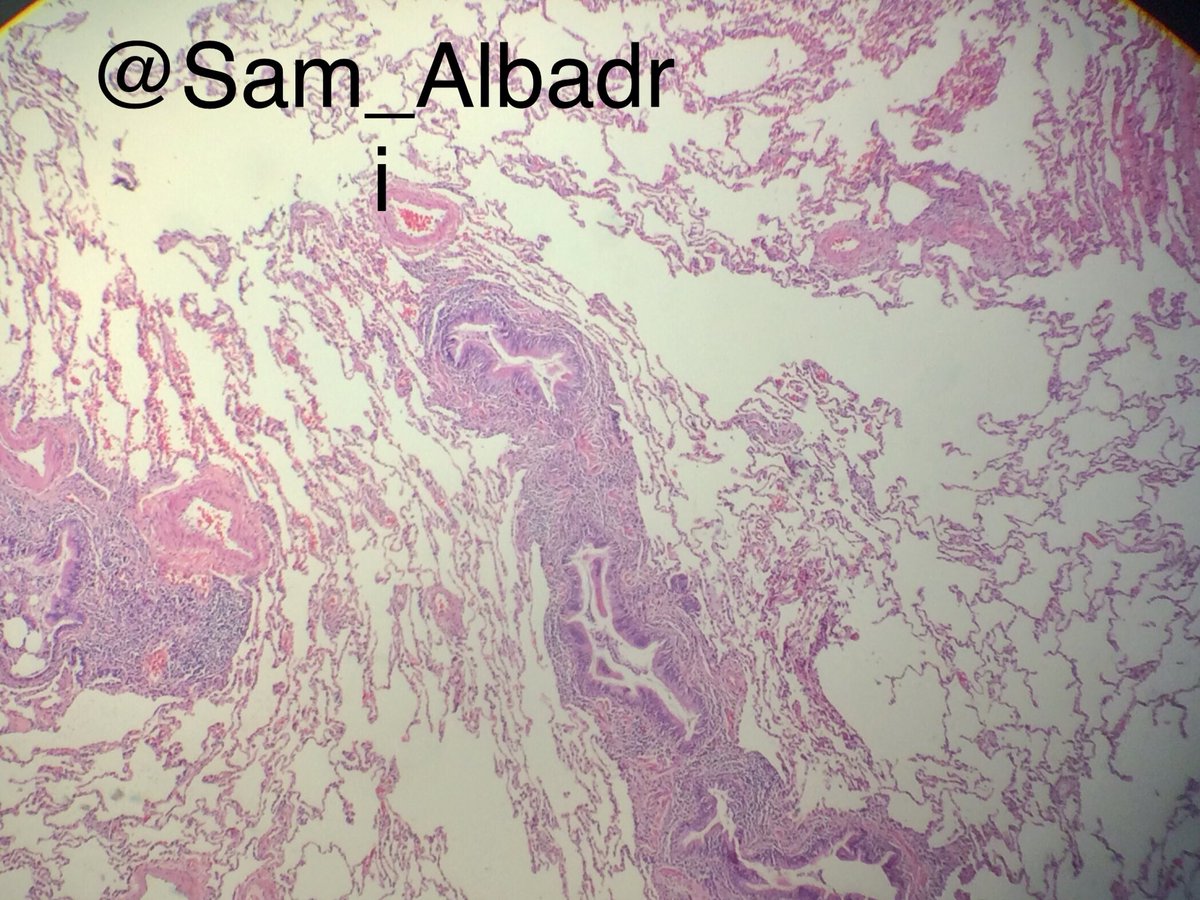sam_albadri's tweet image. Classic picture of connective tissue disease (RA; in this case). Chronic bronchiolitis w mild scarring of small airways &amp;amp; OP @kabeerkshah @GeronimoJrLapac @VijayPatho @LizaMQuintana @marcoslepe @plessthanpt001 @ElshaikhMD @Sinchita_Roy @NadiaUSAMC #Pathologists #pulmonarypath