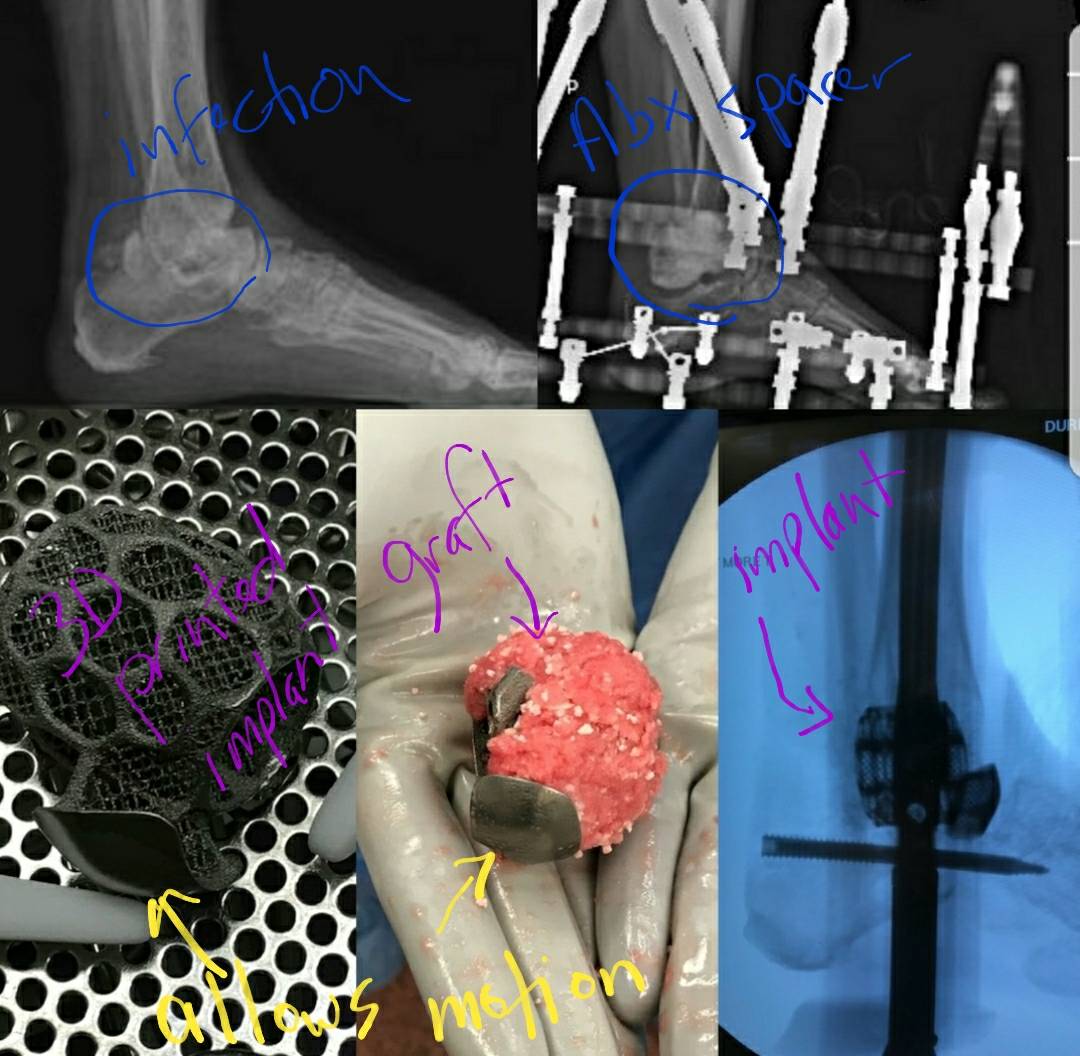seleneparekhmd's tweet image. Novel ways to save limbs after infections of Bones. Using #3Dprinting to replace bones, allow for integration of bone growth, &amp;amp; maintenance of some motion. #TechDoc #AdditiveOrthopaedics
