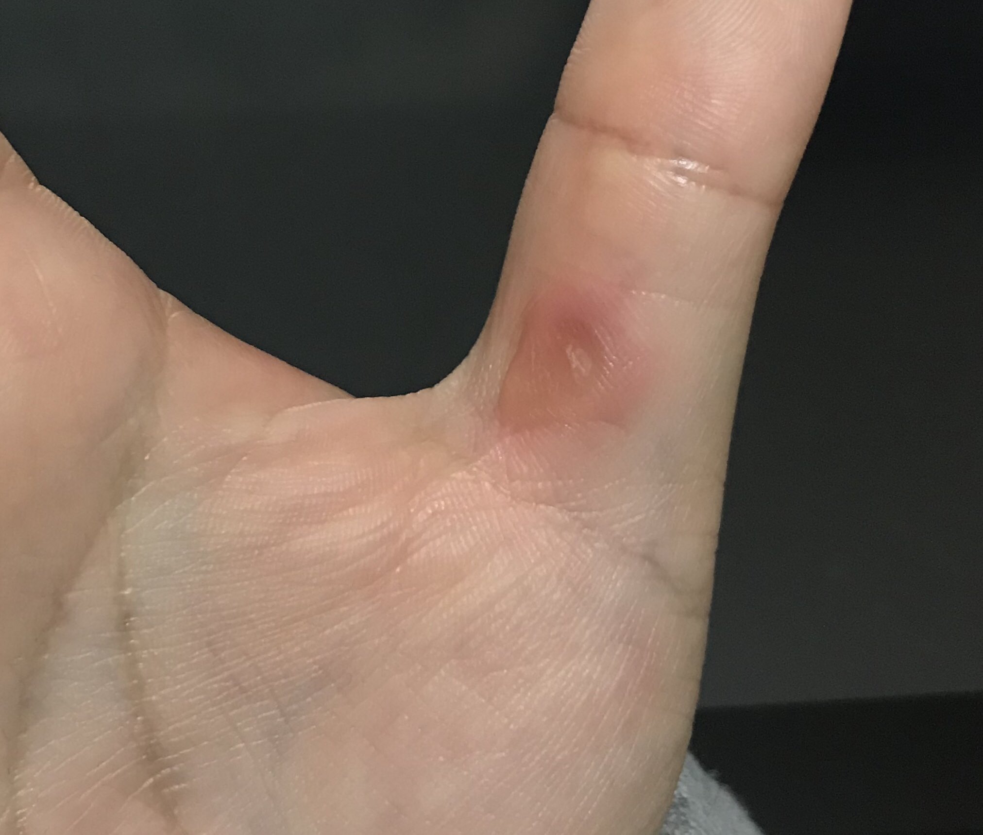 三ツ矢凡人 デジタル作業になってからできた親指のペンだこが痛い T Co Nluffixl1u Twitter