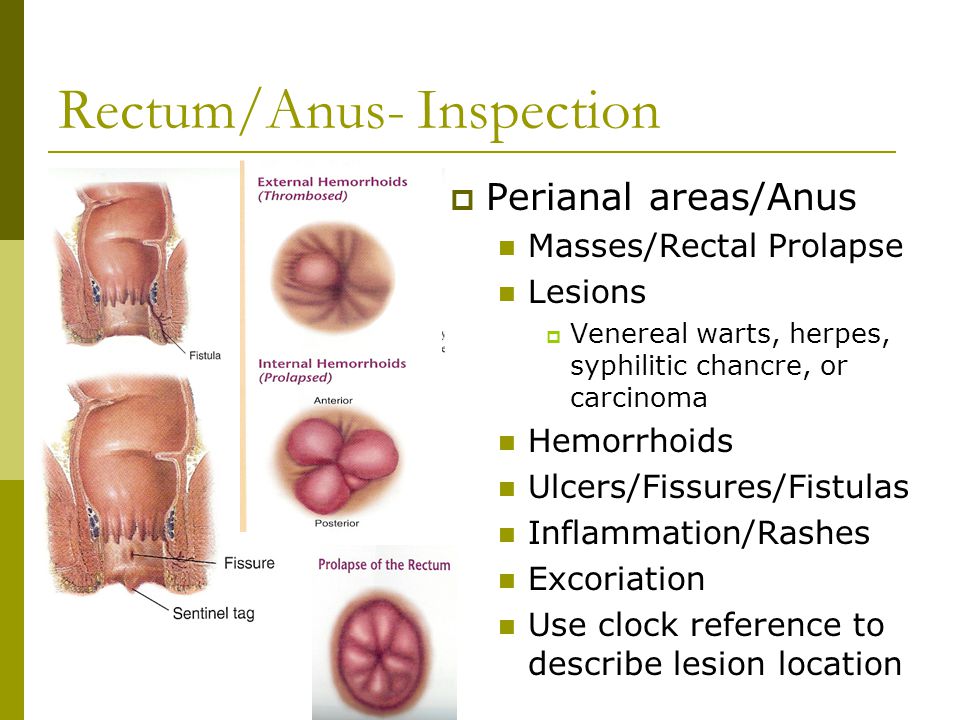 Anus and hpv and hemorrhoids Anus and hpv and hemorrhoids