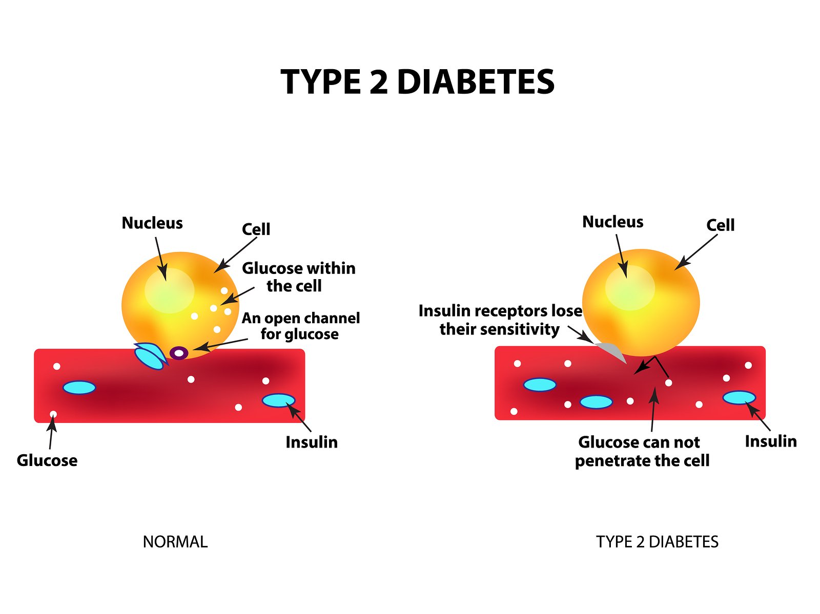 Type 2 Diabetes Pathophysiology Diagram