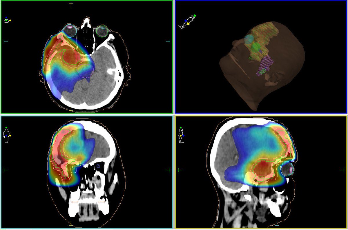Лечение менингиомы в Москве
dr-zavalishin.ru/services/vidi-…

#нейрохирургия #клиниканейрохирургиивмоскве #нейрохирургиявмоскве #нейрохирургиянабабушкинской #остеохондроз #консультациянейрохирурга #лучшийнейрохирургМосквы #нейрохирургиянабабушкинской #нейрохирургзавалишин