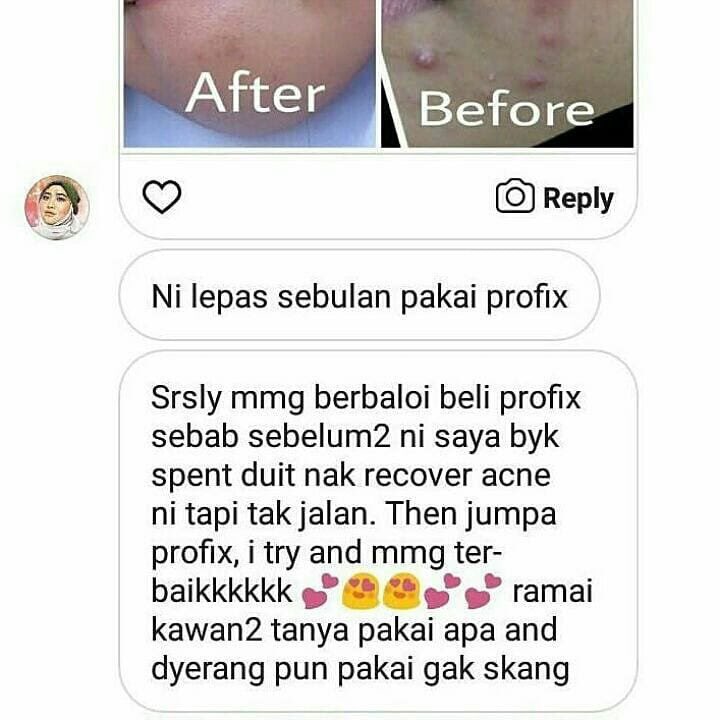 pro_fix12's tweet photo. "Sebelum guna profix, banyak spent duit utk recover acne tapi xjalan!"
Sangat berbaloi beli profix!
#testimoniprofix https://t.co/1xojgOQXEa
