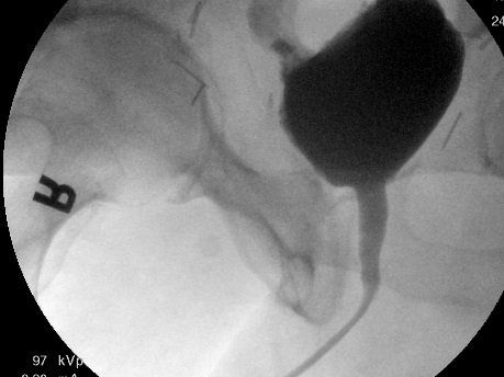 Robotic reconstruction of the Bladder neck with a bladder muscle flap - A new way to correct a vexing problem?  Data still pending but our before and after pix...