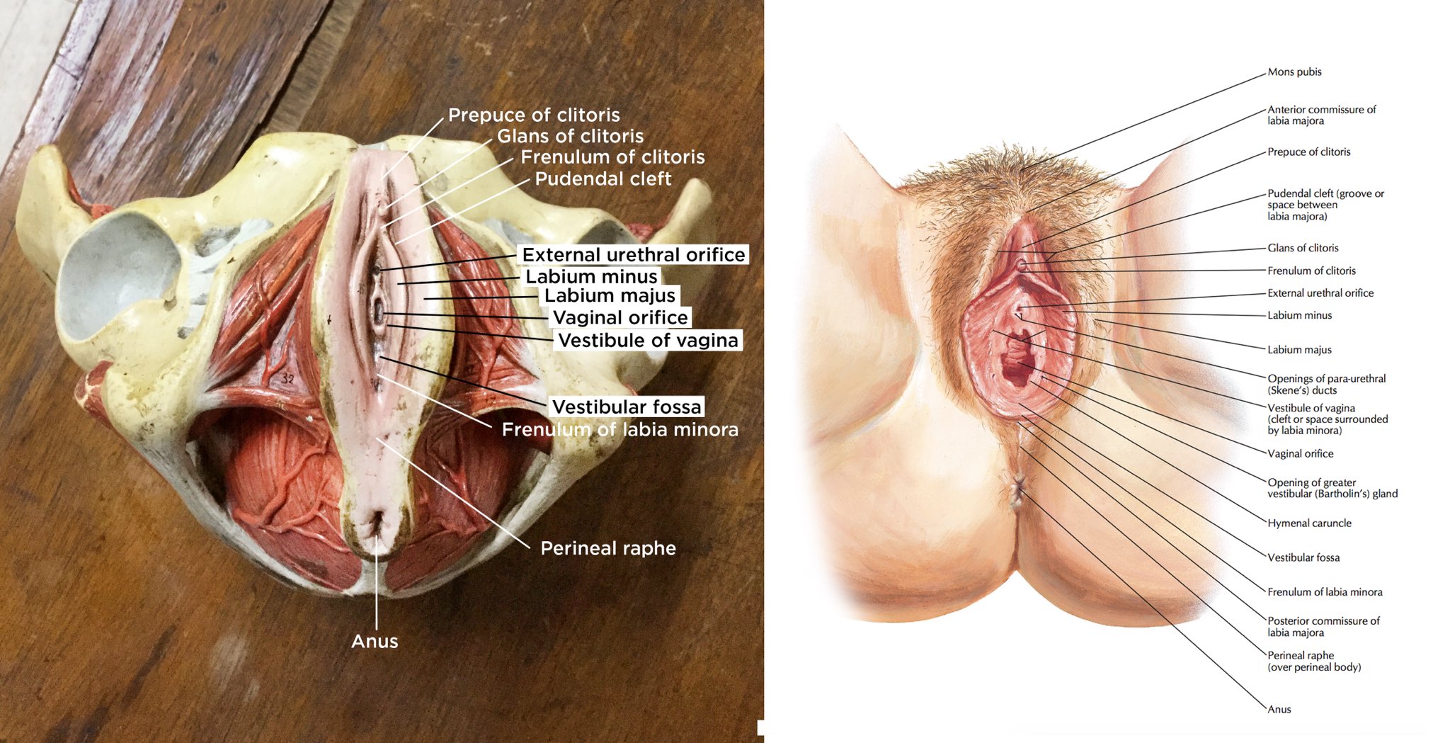 hymenal Pelvic Pain in teens and young women.