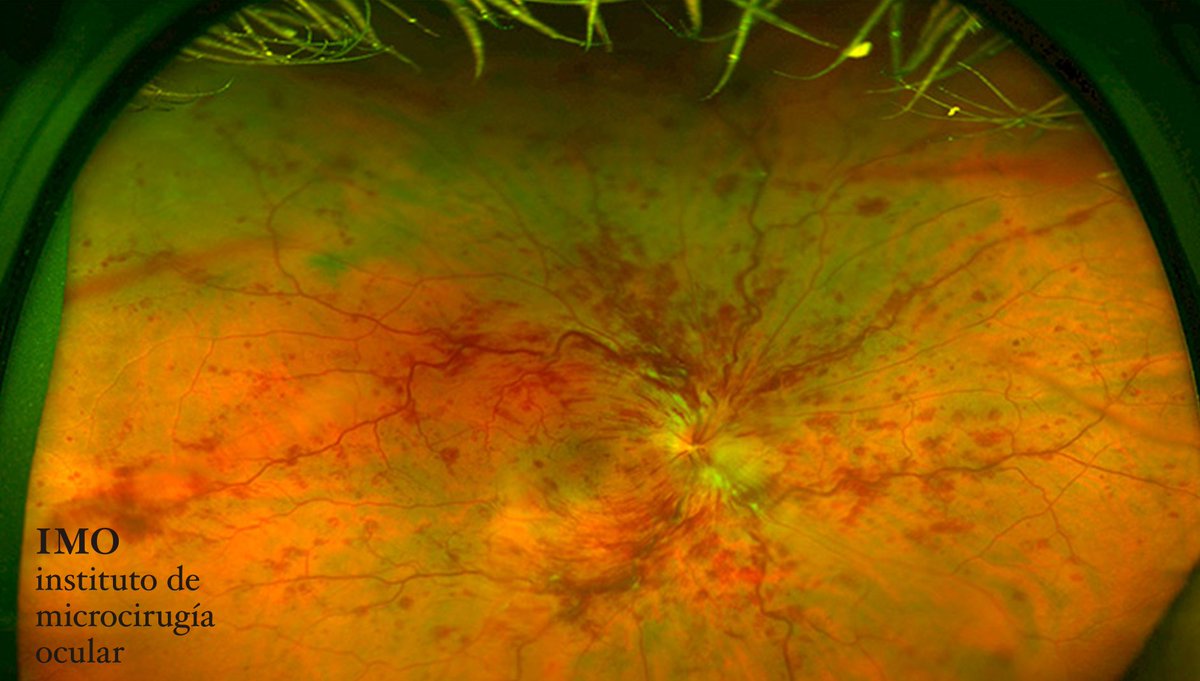 imogrupomiranza's tweet photo. Compartimos 3 medidas preventivas que pueden ayudar a evitar las #oclusiones #venosas de la #retina:
- Control de la tensión arterial
- Control de los índices de colesterol en sangre
- Evitar el hábito tabáquico https://t.co/YBics5ChAr