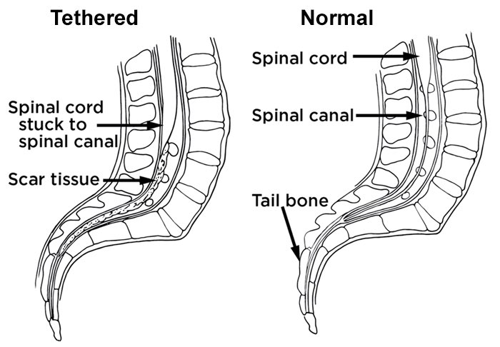 ashwwallace's tweet photo. @juliehershberg @manjiridahdul h/o back pain + progressive, asymmetric motor/sensory loss distal>prox in dermatomal pattern. LBP + radiating sxs, right? Consider this curveball: Spina Bifida & tethered cord release in PMH! MRI shows presence of secondary tethered cord #PT546week4 https://t.co/FExmSPuWEZ