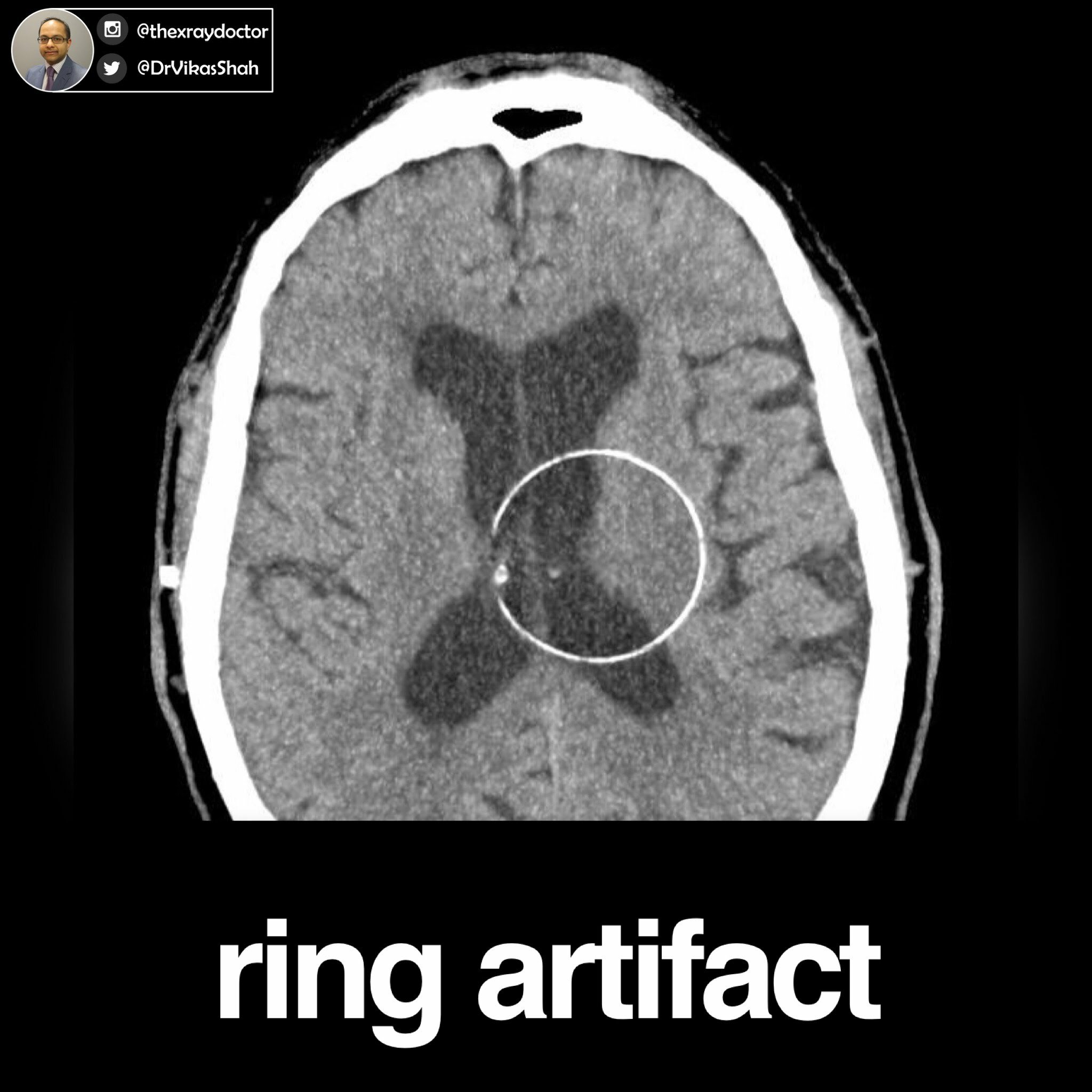 The ring nature of the CT artefact is well demonstrated in the absence... |  Download Scientific Diagram
