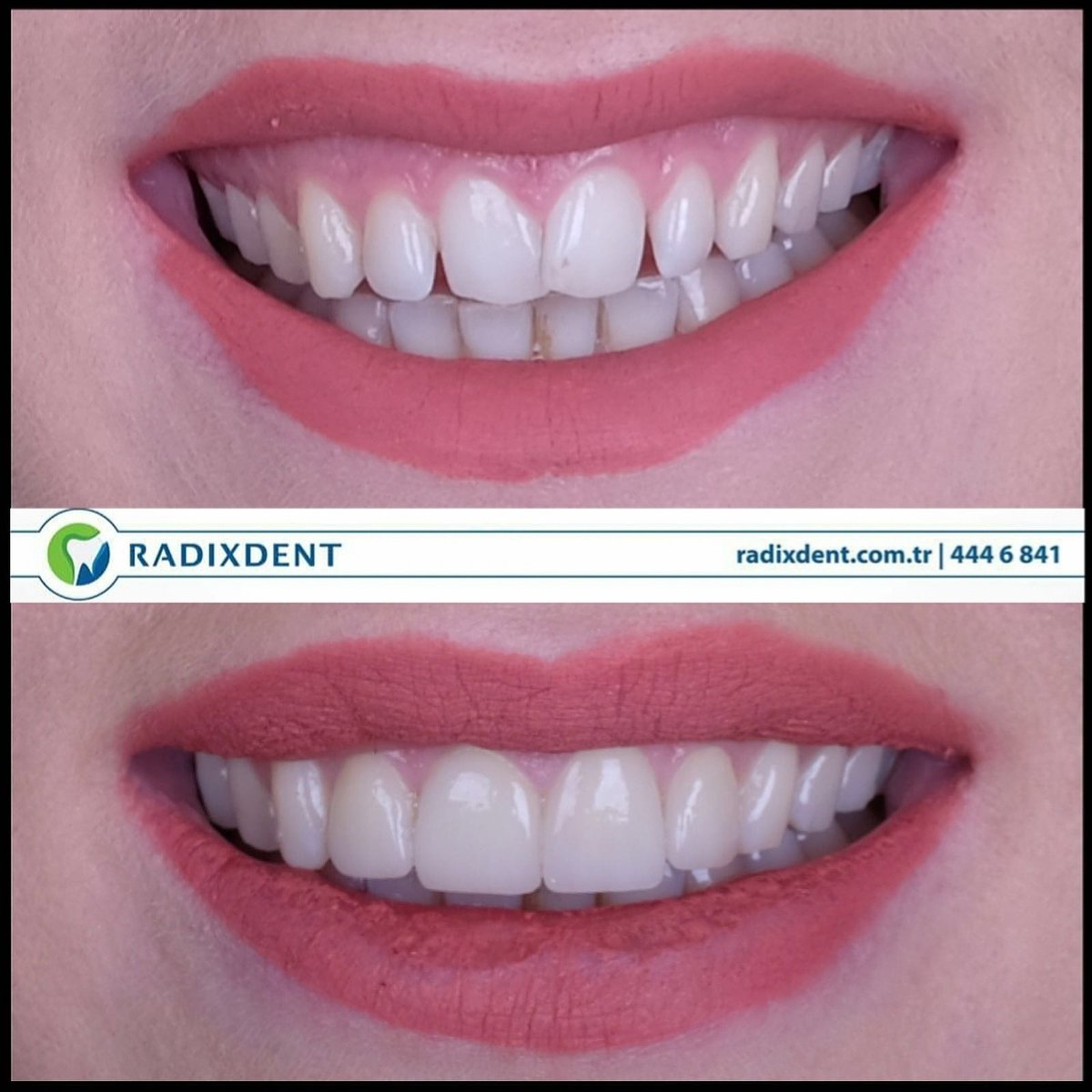 radixdent's tweet photo. #radixdent #kartal #istanbul #dishastanesi#smile #gülümse #laminateveneer
Dişlerinizin görünüşüne üzülüp gülüşünüzü gizlemeyin.Sandığınızdan daha basit dokunuşlarla harika bir gülüş elde edebilirsiniz.
Hastamızın sadece 4 dişine dokunarak harika bir gülüş estetiği yakaladık https://t.co/y7QJzMYxme