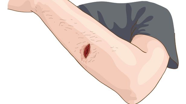 woundwizardemr's tweet photo. WoundCare, a wound monitoring app, allows patients to remotely send images of surgical wounds for monitoring: https://t.co/7was129PTI https://t.co/yvd7yyH70y