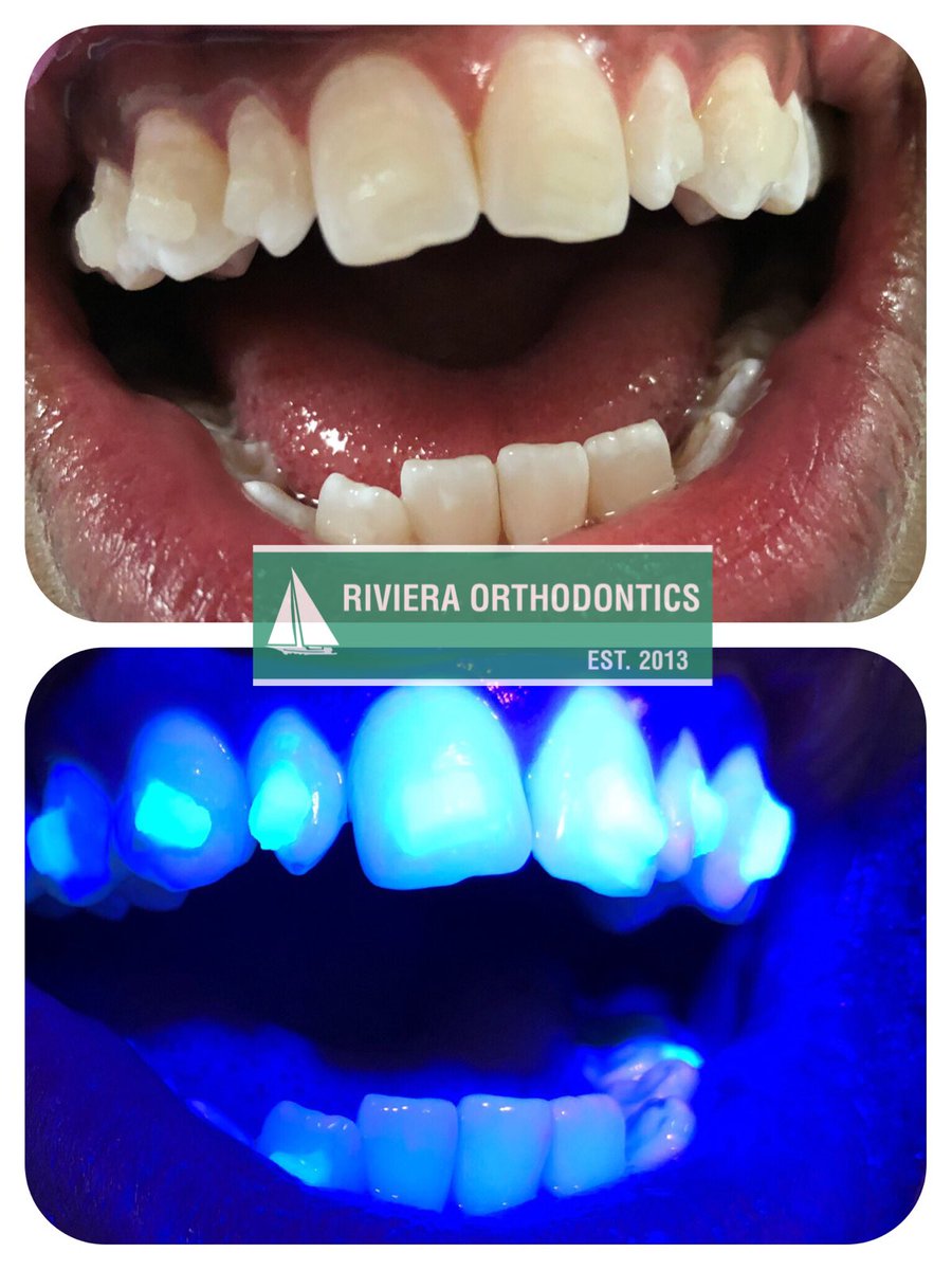 Glow in the dark #Invisalign attachments