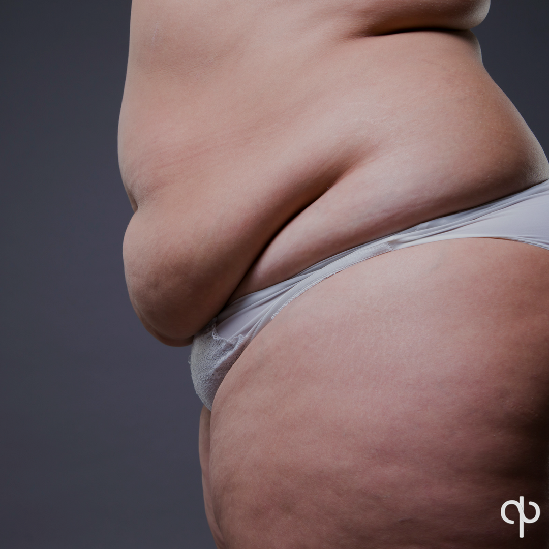 PabloPrichard's tweet photo. Dr. Prichard is capable of providing his patients with drastically noticeable enhancements in the overall shape and contours of one’s waist and abdomen. A tummy tuck also helps to erase any stretch marks, which helps in creating a youthful, flawless midriff. https://t.co/BJUMuDNXOf
