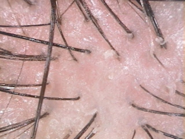 毛根抜け毛研究家 生沼研 در توییتر 豚毛ブラシ シャンプー1時間後 頭皮写真 昨日とあまりかわっていないかも 毛穴に角栓 ブラッシングブラシ 豚毛ブラシ 頭皮 フケ 頭かゆい 角栓