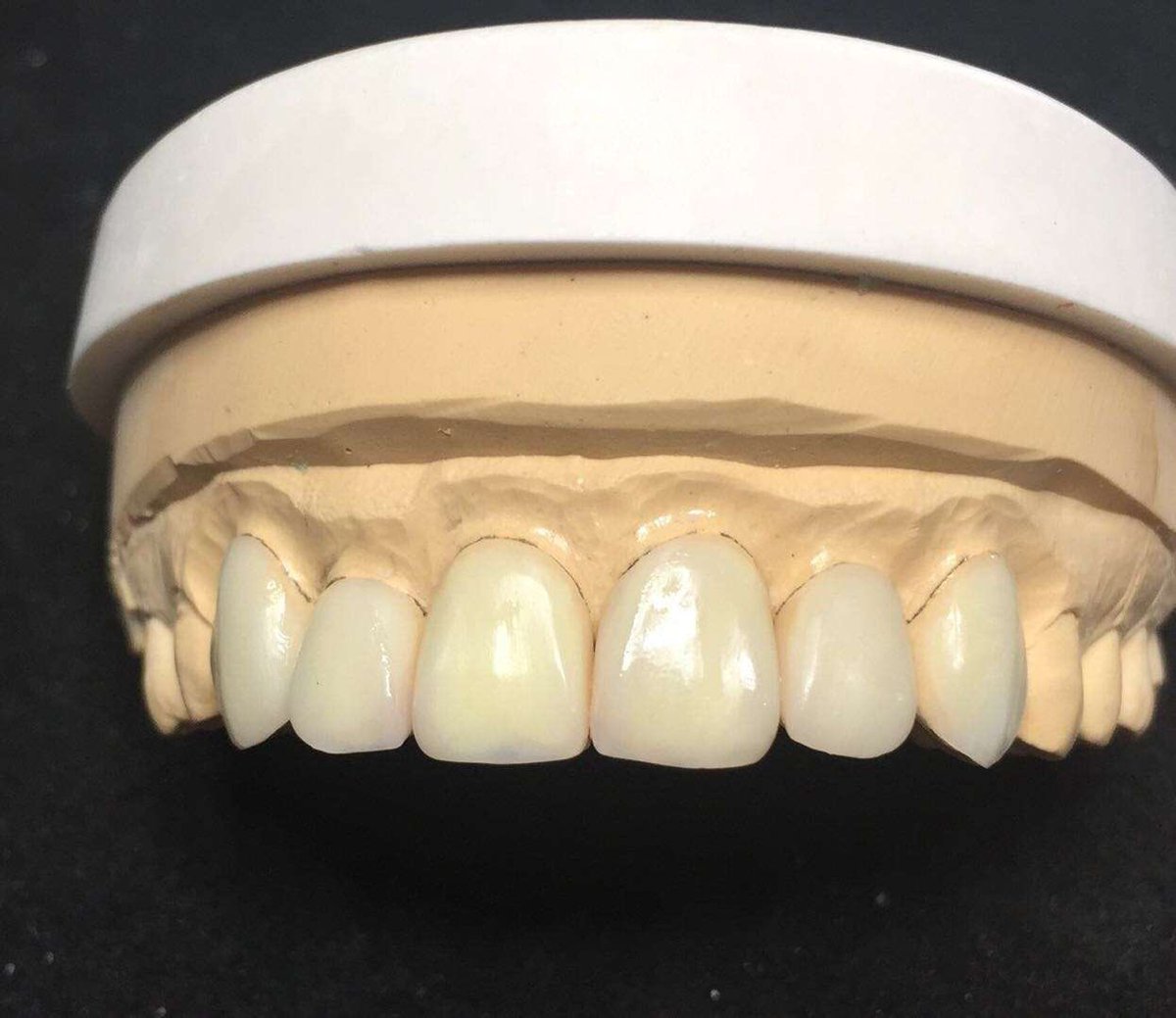 TOP_dentallab's tweet photo. Veneer case 😉#prothestic #topdental #topdentallab #veneer #veneers #dailycase #dental #dentistry #dentallab #dentallaboratory #dentalworld #outsourcing #smile #allceramic #technician #denture #implant #implants https://t.co/2mlbMrv2KF