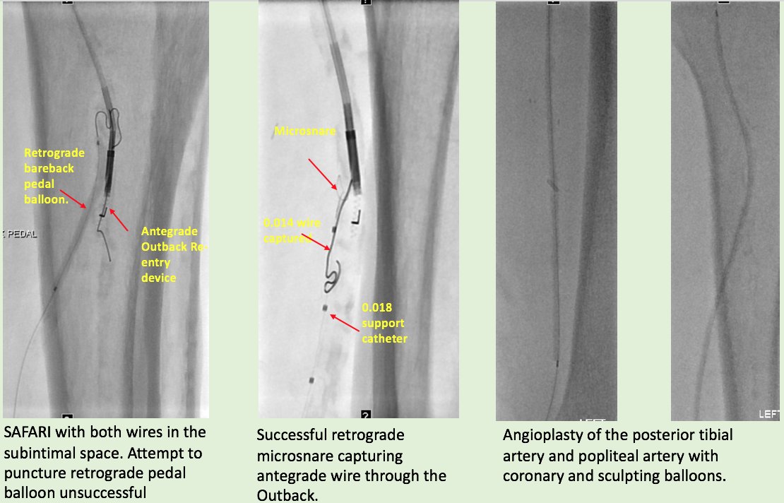 kmadass's tweet photo. Pt 1-We fight to #StopTheChop when option is an amputation. 70yrM RS5 with recc of amp by OSH after failed bypass. @arslanmd #SaveALegSaveALife @Drshiloh @SDhandMD @keithppereira @robsheridanavir @LessneVIR @ajgunnmd @DrAlHarbiA_Aziz @SOBE_Vascular @Watts_IR @AlexCVIR @SIRRFS https://t.co/ci6L0750Gb