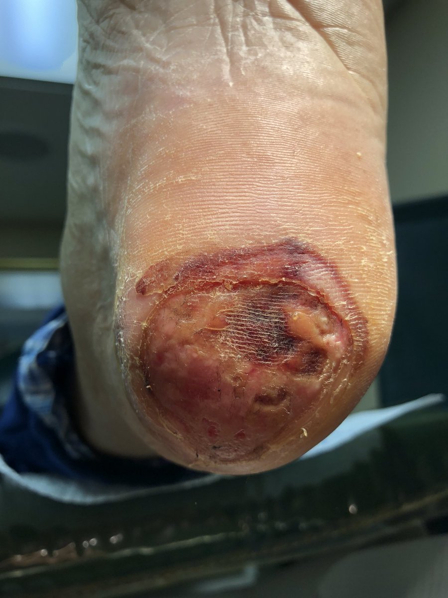 WoundSmart's tweet photo. Decubitus ulcerations continue to be common source of infection in the #geriatric population #foot #Ulceration https://t.co/mV8lG8dk3S