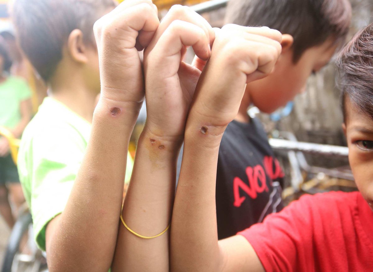 A GANG PROBLEM. Children, whose ages range from 9 to 11 years old, show the cigarette  burn marks on their wrists