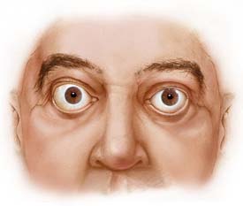 как называются выпуклые глаза. базедова болезнь пучеглазие. пучеглазие заболевание щитовидной железы. тиреотоксический экзофтальм. базедова болезнь экзофтальм.